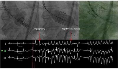 Case Report: Sapien 3 Transcatheter Heart Valve Embolization: Cause, Management, and Redo